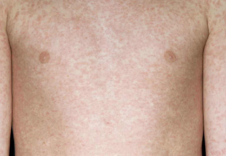Two Kids Dead as Measles Cases Surge Across UK