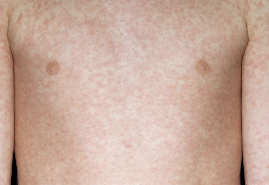 Two Kids Dead as Measles Cases Surge Across UK