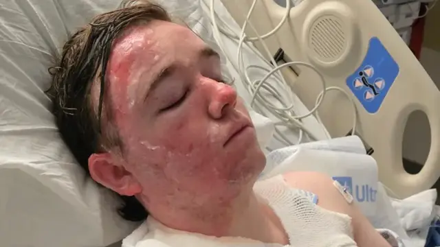McDonald’s Worker in ICU After Hot Oil Attack by Co-Worker